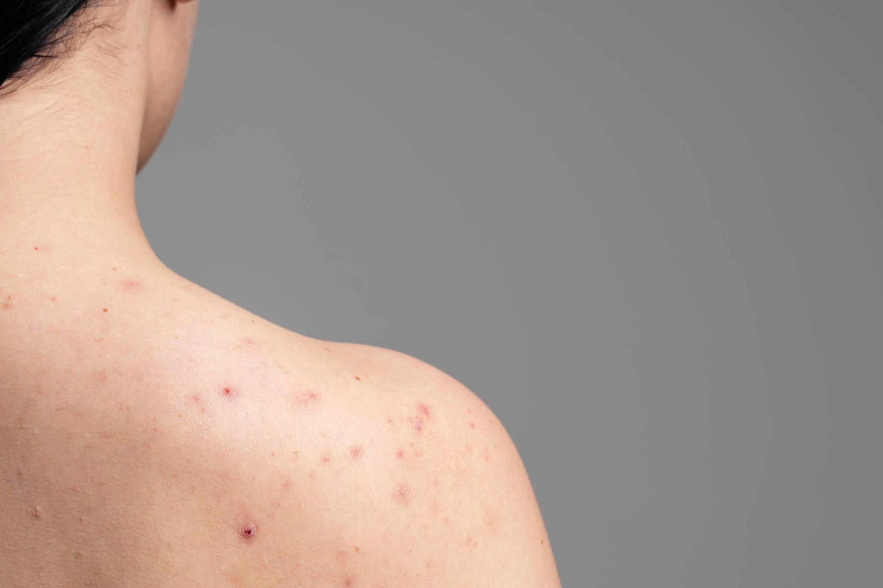 Symptoms of Measles: सर्दी समझने की न करें भूल, खसरा बीमारी की ऐसे करें पहचान