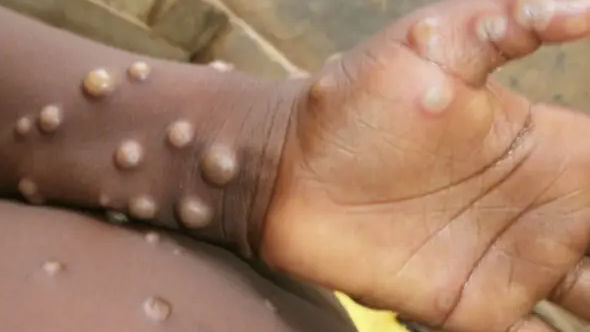 Monkeypox क्या है? दुनिया के कई देशों में मचा रहा तबाही