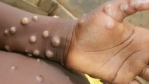 Monkeypox Virus: मंकीपॉक्स ने 12 देशों में दी दस्तक, WHO ने दी ये चेतावनी