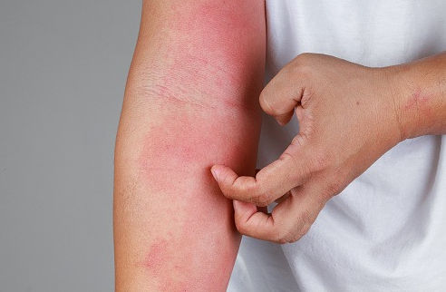 गर्मियों की तेज धूप से हो सकती है Sun Poisoning, जानें इसके लक्षण और बचाव