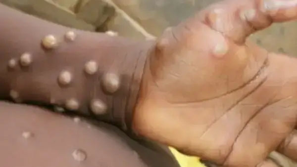 Monkeypox virus को लेकर UP सरकार अलर्ट, जारी की गाइडलाइन