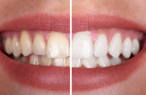 Teeth Care: क्या आप दांतों के पीलेपन से हैं परेशान? अपनाएं ये 4 अचूक उपाय
