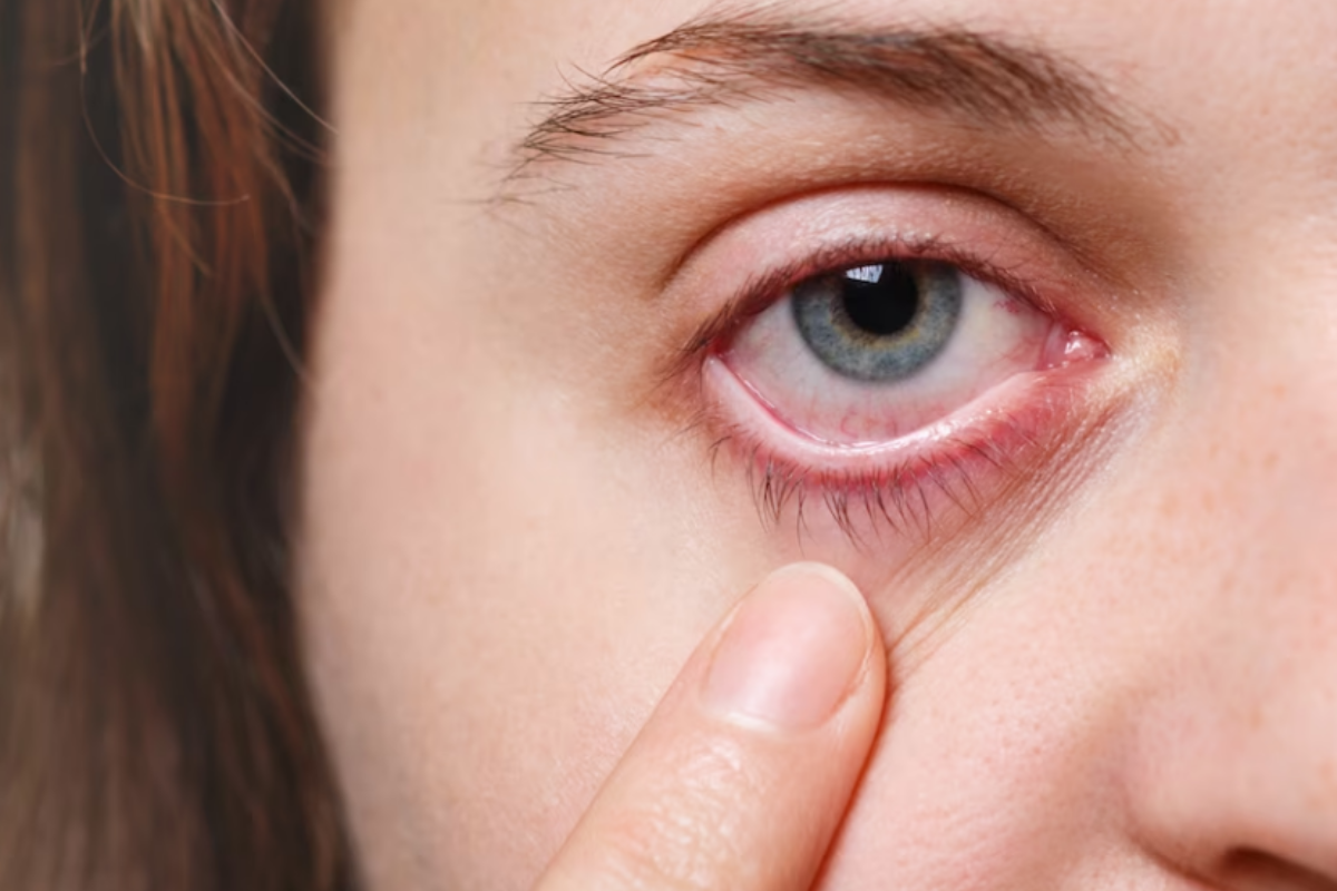 Eye Flu: आई फ्लू कैसे होता है? जान लें कारण, लक्षण और उपाय वरना सारा काम काज हो जाएगा ठप्प